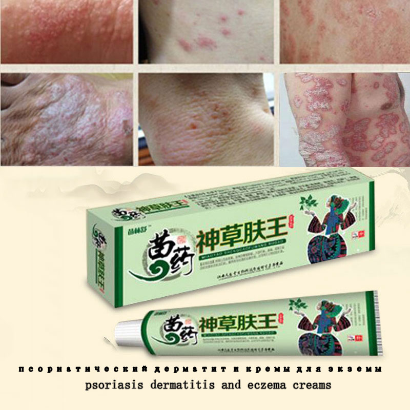 Natural Herbal Psoriasis Cream Perfect For Dermatitis and Eczema ...